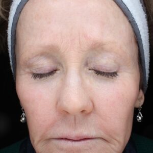 HALO Before and After Photo by Coachlight Clinic & Spa in West Des Moines Iowa
