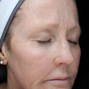 HALO Before and After Photo by Coachlight Clinic & Spa in West Des Moines Iowa