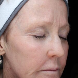 HALO Before and After Photo by Coachlight Clinic & Spa in West Des Moines Iowa