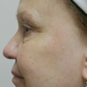 HALO Before and After Photo by Coachlight Clinic & Spa in West Des Moines Iowa