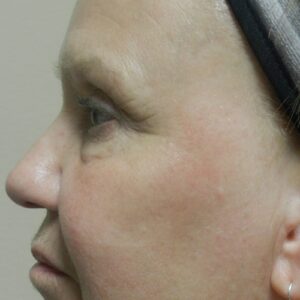 HALO Before and After Photo by Coachlight Clinic & Spa in West Des Moines Iowa