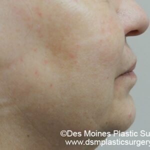 HALO Before and After Photo by Coachlight Clinic & Spa in West Des Moines Iowa