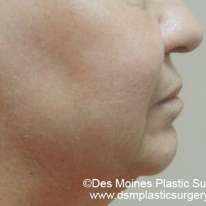 HALO Before and After Photo by Coachlight Clinic & Spa in West Des Moines Iowa