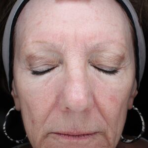 HALO Before and After Photo by Coachlight Clinic & Spa in West Des Moines Iowa