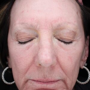 HALO Before and After Photo by Coachlight Clinic & Spa in West Des Moines Iowa