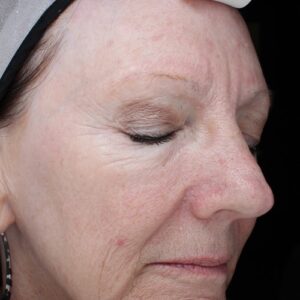 HALO Before and After Photo by Coachlight Clinic & Spa in West Des Moines Iowa
