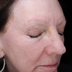 HALO Before and After Photo by Coachlight Clinic & Spa in West Des Moines Iowa