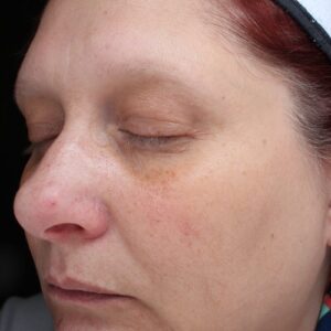 HALO Before and After Photo by Coachlight Clinic & Spa in West Des Moines Iowa
