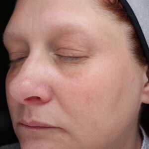 HALO Before and After Photo by Coachlight Clinic & Spa in West Des Moines Iowa