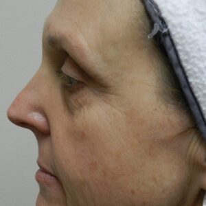HALO Before and After Photo by Coachlight Clinic & Spa in West Des Moines Iowa