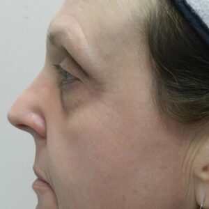 HALO Before and After Photo by Coachlight Clinic & Spa in West Des Moines Iowa