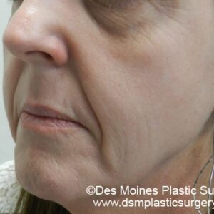 HALO Before and After Photo by Coachlight Clinic & Spa in West Des Moines Iowa