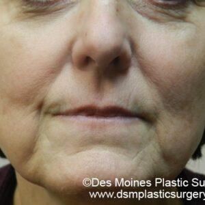 HALO Before and After Photo by Coachlight Clinic & Spa in West Des Moines Iowa