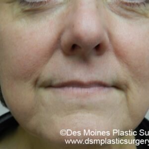 HALO Before and After Photo by Coachlight Clinic & Spa in West Des Moines Iowa