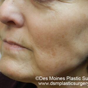 HALO Before and After Photo by Coachlight Clinic & Spa in West Des Moines Iowa