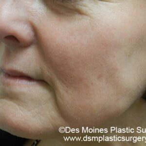 HALO Before and After Photo by Coachlight Clinic & Spa in West Des Moines Iowa