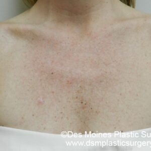 HALO Before and After Photo by Coachlight Clinic & Spa in West Des Moines Iowa