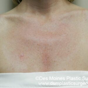 HALO Before and After Photo by Coachlight Clinic & Spa in West Des Moines Iowa