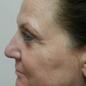 HALO Before and After Photo by Coachlight Clinic & Spa in West Des Moines Iowa