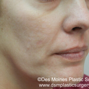 HALO Before and After Photo by Coachlight Clinic & Spa in West Des Moines Iowa