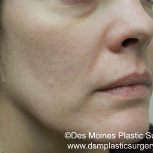 HALO Before and After Photo by Coachlight Clinic & Spa in West Des Moines Iowa