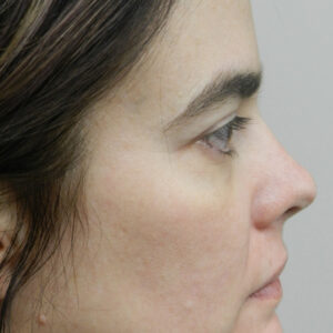 HALO Before and After Photo by Coachlight Clinic & Spa in West Des Moines Iowa