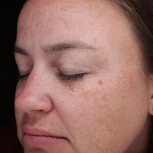 Halo treatment Before and After Photo by Coachlight Clinic Spa in West Des Moines Iowa