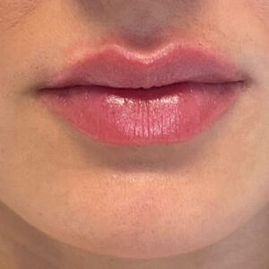 Lip Filler Before and After Photo by Coachlight Clinic & Spa in West Des Moines Iowa