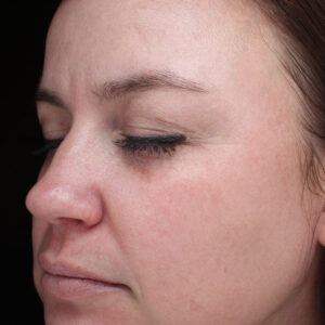Halo treatment Before and After Photo by Coachlight Clinic Spa in West Des Moines Iowa