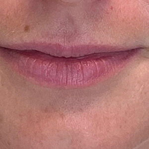 Lip Filler Before and After Photo by Coachlight Clinic & Spa in West Des Moines Iowa