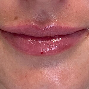 Lip Filler Before and After Photo by Coachlight Clinic & Spa in West Des Moines Iowa