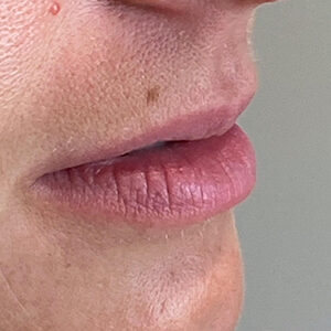 Lip Filler Before and After Photo by Coachlight Clinic & Spa in West Des Moines Iowa