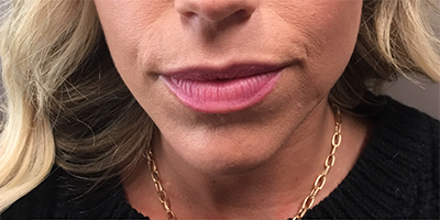 Lip Filler Before and After Photo by Coachlight Clinic & Spa in West Des Moines Iowa
