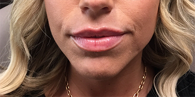 Lip Filler Before and After Photo by Coachlight Clinic & Spa in West Des Moines Iowa