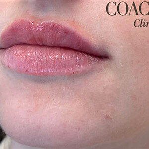 Lip Filler Before and After Photo by Coachlight Clinic & Spa in West Des Moines Iowa