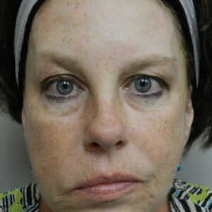 BBL® & BBL® HERO™ Before and After Photo by Coachlight Clinic & Spa in West Des Moines Iowa
