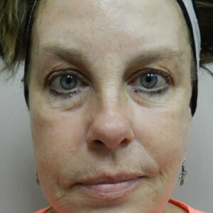 BBL® & BBL® HERO™ Before and After Photo by Coachlight Clinic & Spa in West Des Moines Iowa