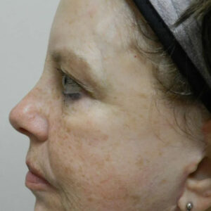 BBL® & BBL® HERO™ Before and After Photo by Coachlight Clinic & Spa in West Des Moines Iowa