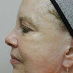 BBL® & BBL® HERO™ Before and After Photo by Coachlight Clinic & Spa in West Des Moines Iowa
