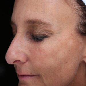 BBL® & BBL® HERO™ Before and After Photo by Coachlight Clinic & Spa in West Des Moines Iowa