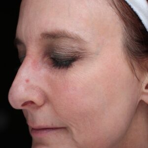 BBL® & BBL® HERO™ Before and After Photo by Coachlight Clinic & Spa in West Des Moines Iowa
