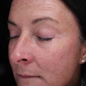 BBL® & BBL® HERO™ Before and After Photo by Coachlight Clinic & Spa in West Des Moines Iowa