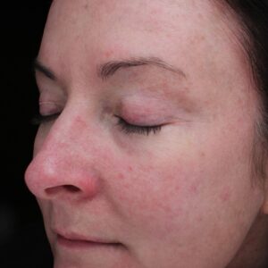 BBL® & BBL® HERO™ Before and After Photo by Coachlight Clinic & Spa in West Des Moines Iowa