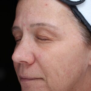 BBL® & BBL® HERO™ Before and After Photo by Coachlight Clinic & Spa in West Des Moines Iowa