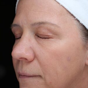 BBL® & BBL® HERO™ Before and After Photo by Coachlight Clinic & Spa in West Des Moines Iowa