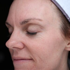 BBL® & BBL® HERO™ Before and After Photo by Coachlight Clinic & Spa in West Des Moines Iowa
