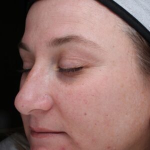 BBL® & BBL® HERO™ Before and After Photo by Coachlight Clinic & Spa in West Des Moines Iowa