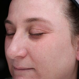 BBL® & BBL® HERO™ Before and After Photo by Coachlight Clinic & Spa in West Des Moines Iowa