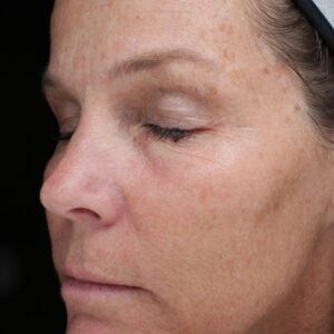 BBL® & BBL® HERO™ Before and After Photo by Coachlight Clinic & Spa in West Des Moines Iowa