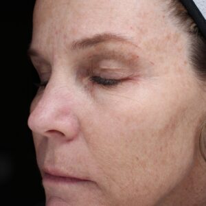 BBL® & BBL® HERO™ Before and After Photo by Coachlight Clinic & Spa in West Des Moines Iowa